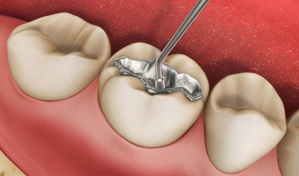 obturação de amálgama