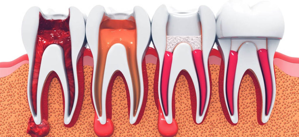 O Que é Endodontia E Como A Especialidade Ajuda O Meu Sorriso? - Eliana ...